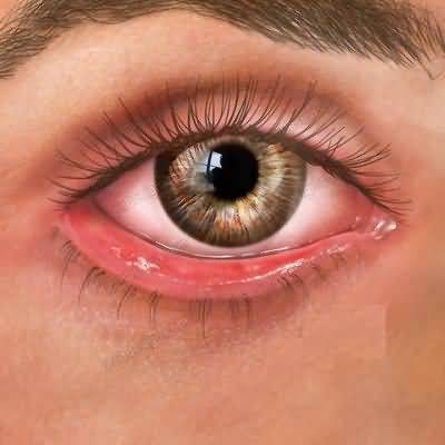 allergic Eye Disease